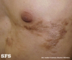 linear scleroderma