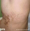 linear scleroderma