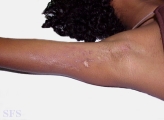 linear scleroderma