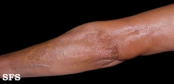 linear scleroderma