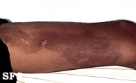 linear scleroderma