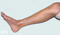 linear scleroderma