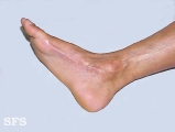 linear scleroderma