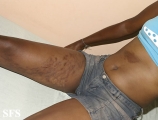 linear scleroderma