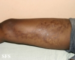 linear scleroderma