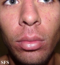 mononucleosis-ampicillin syndrome