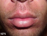 mononucleosis-ampicillin syndrome