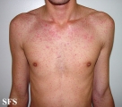 mononucleosis-ampicillin syndrome