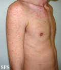 mononucleosis-ampicillin syndrome