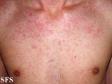 mononucleosis-ampicillin syndrome