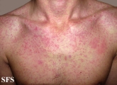 mononucleosis-ampicillin syndrome