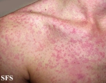 mononucleosis-ampicillin syndrome
