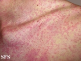 mononucleosis-ampicillin syndrome