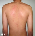 mononucleosis-ampicillin syndrome