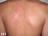 mononucleosis-ampicillin syndrome