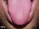 mononucleosis-ampicillin syndrome