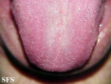 mononucleosis-ampicillin syndrome