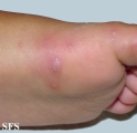 hand-food-and-mouth disease