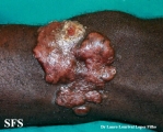blastomycosis-keloidal blastomycosis