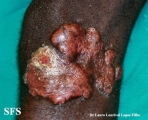 blastomycosis-keloidal blastomycosis