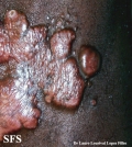 blastomycosis-keloidal blastomycosis