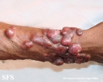 blastomycosis-keloidal blastomycosis