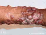 blastomycosis-keloidal blastomycosis
