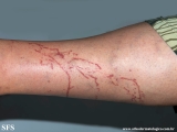 portuguese man of war dermatitis