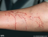 portuguese man of war dermatitis
