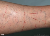 portuguese man of war dermatitis