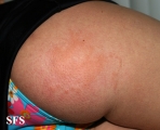 portuguese man of war dermatitis