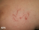 portuguese man of war dermatitis