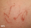 portuguese man of war dermatitis