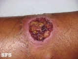 tropical ulcer