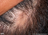 lichen planus follicularis