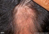 lichen planus follicularis