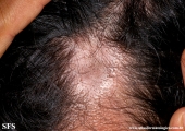 lichen planus follicularis