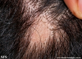 lichen planus follicularis