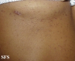 lichen planus follicularis