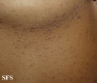 lichen planus follicularis