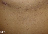 lichen planus follicularis