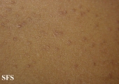 lichen planus follicularis
