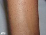 lichen planus follicularis