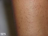 lichen planus follicularis
