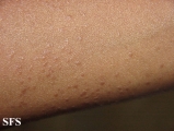 lichen planus follicularis