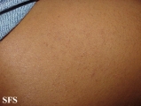 lichen planus follicularis