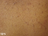 lichen planus follicularis