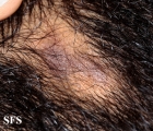 lichen planus follicularis