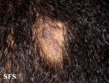 lichen planus follicularis