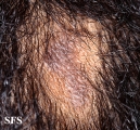 lichen planus follicularis